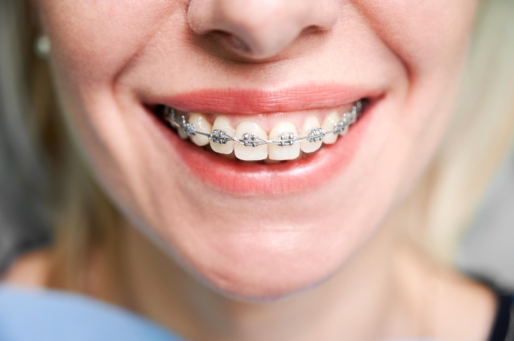 smiling-young-woman-with-braces-teeth