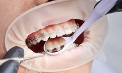 Diş teli tedavisinde temizliğe dikkat